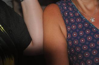 Close-up of a sunburned arm next to an untanned arm